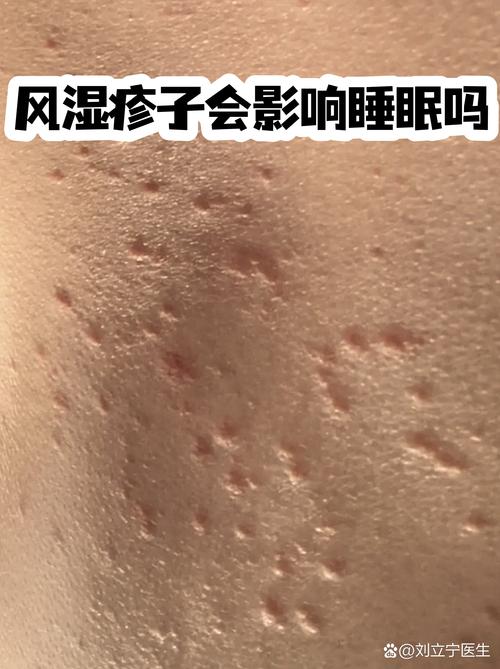 风湿热为什么是弛张热