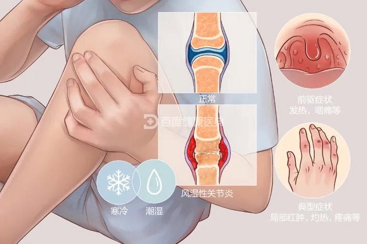 风湿热为什么是弛张热