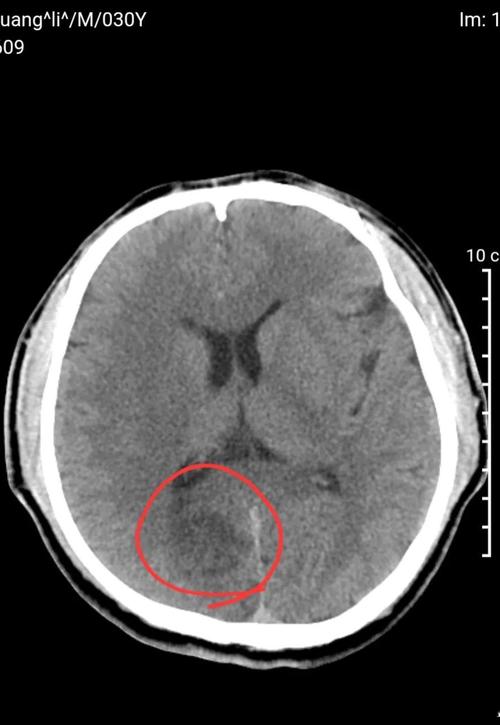 新鲜脑梗陈旧脑梗CT