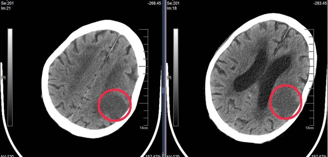 新鲜脑梗陈旧脑梗CT