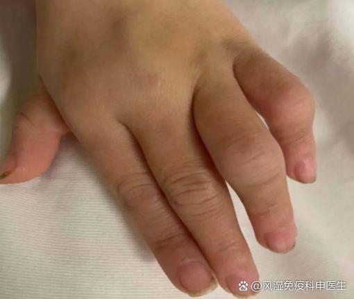 孩子会得风湿性关节炎