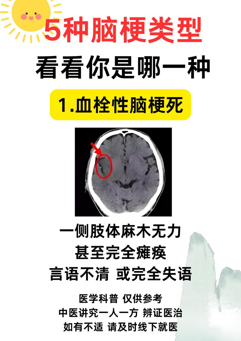 脑出血十年后出现脑梗