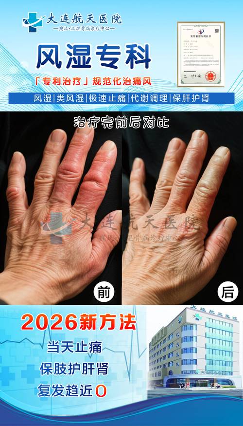 风湿性关节炎入院记录