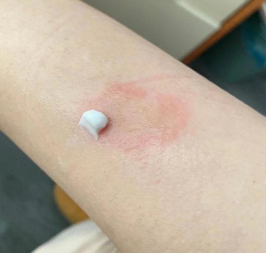 风湿性关节炎环形红斑