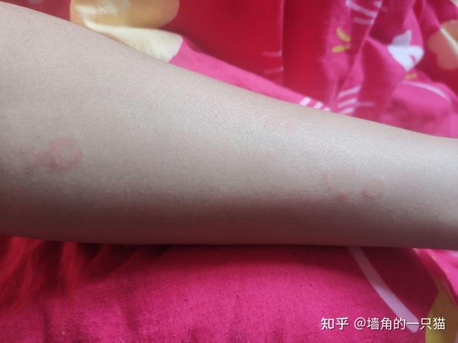 风湿性关节炎环形红斑