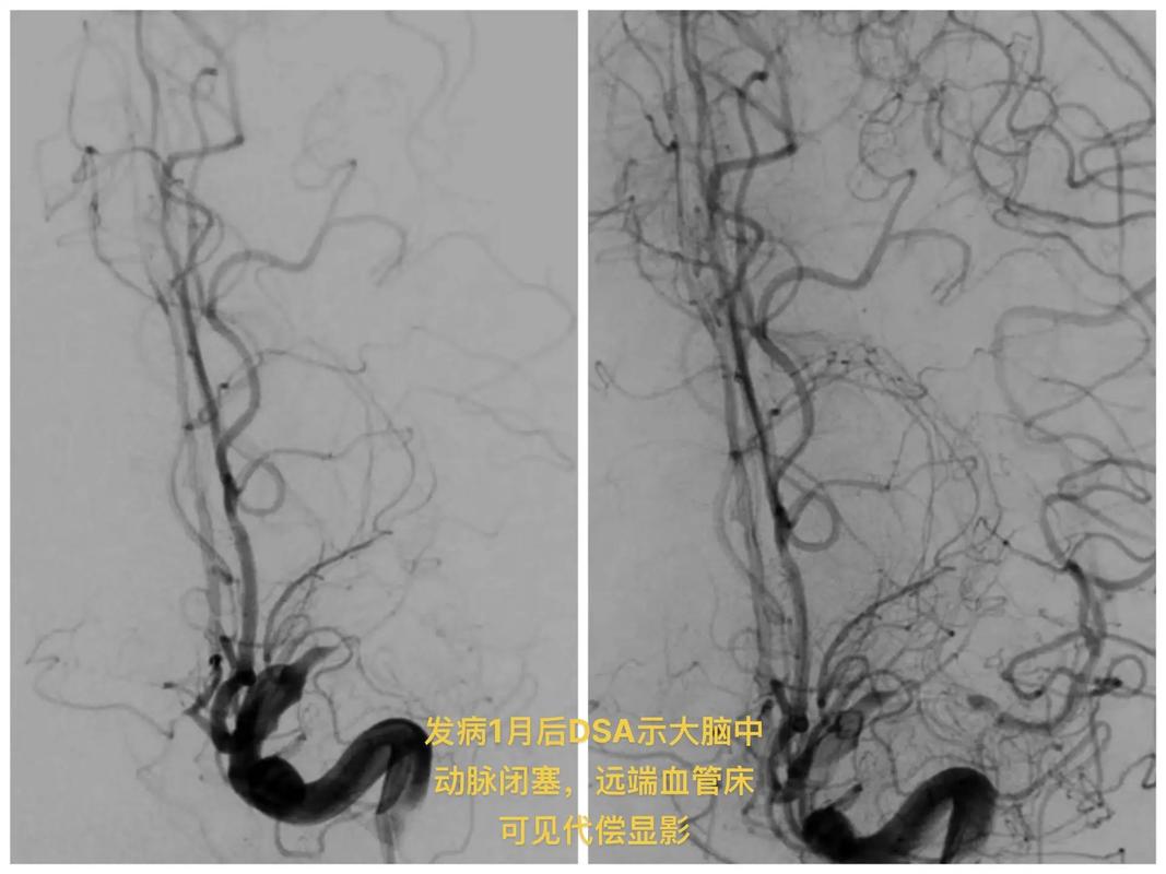 二尖瓣狭窄无症状脑梗