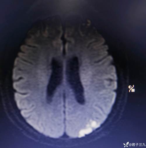 二尖瓣狭窄无症状脑梗