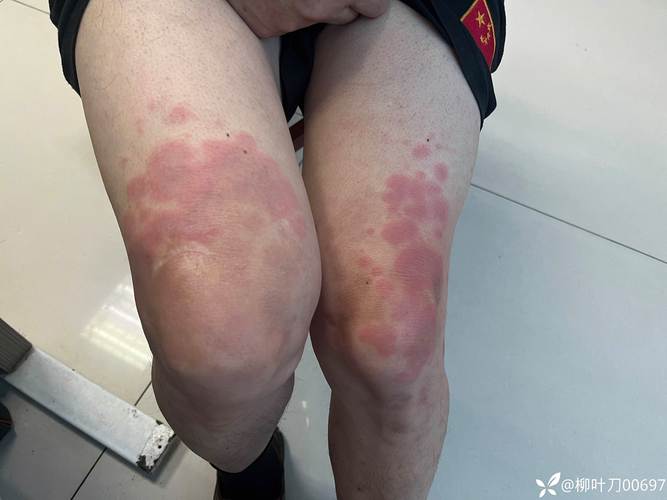 膝盖处风湿病小红点图