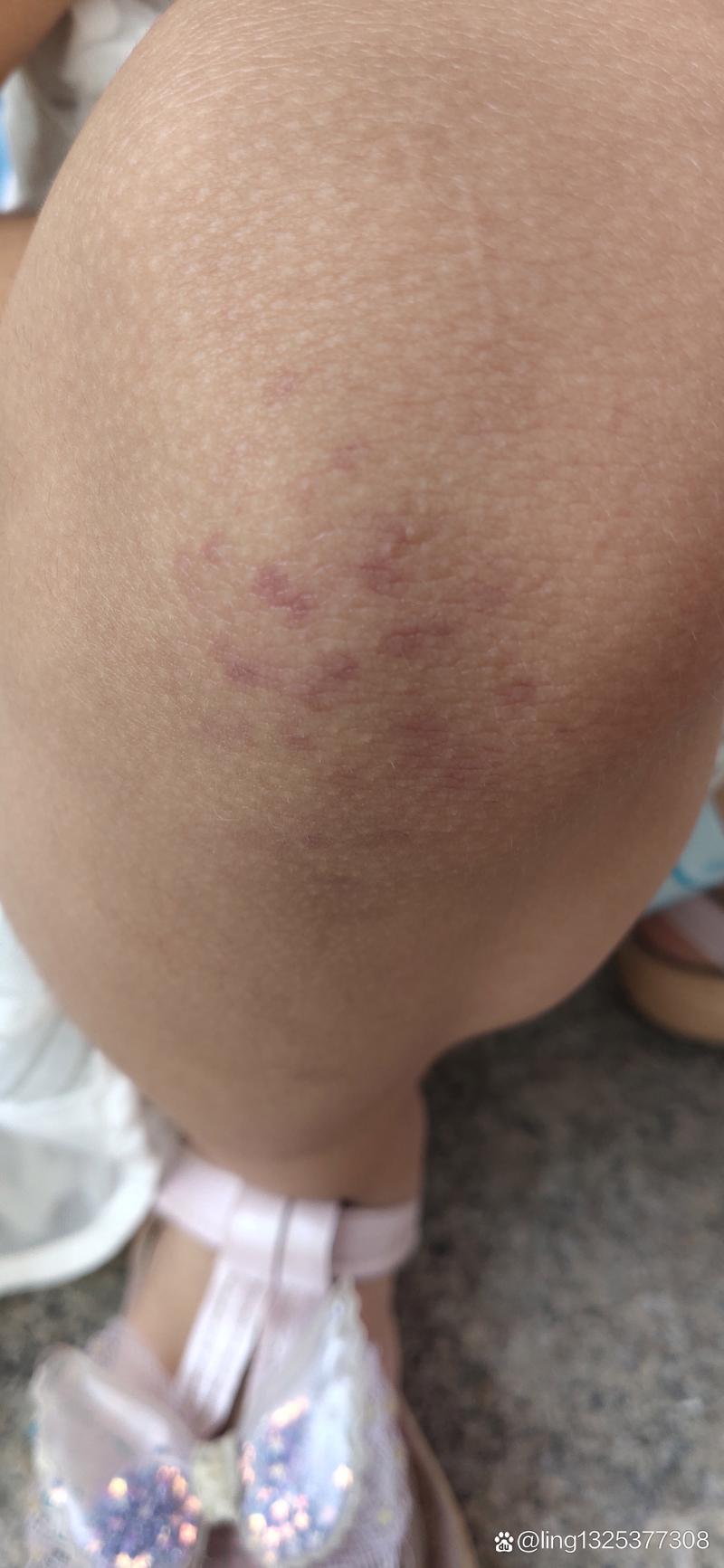 膝盖处风湿病小红点图