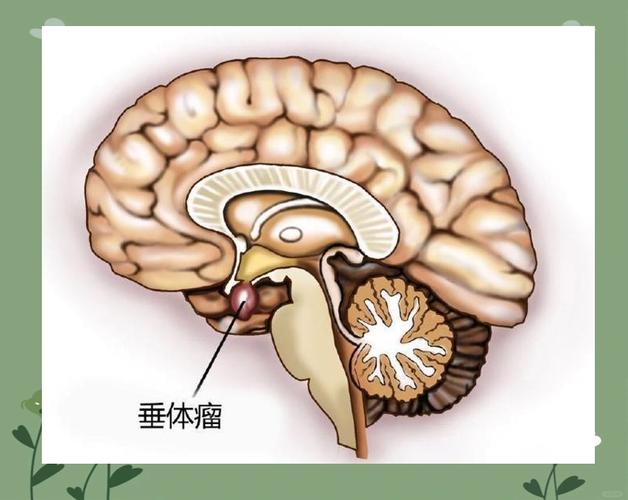 垂体瘤和脑梗有关系吗