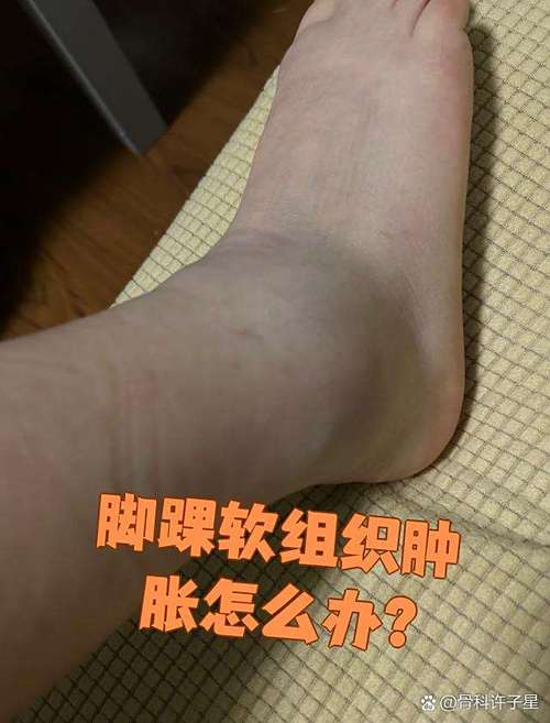 类风湿会引起脚脖肿吗