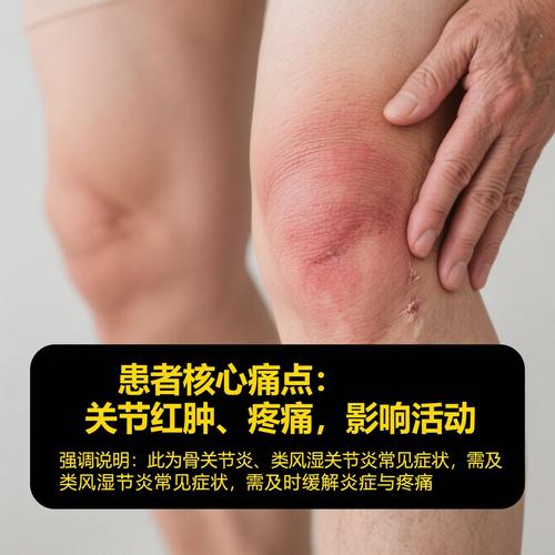 治疗类风湿关节炎首选