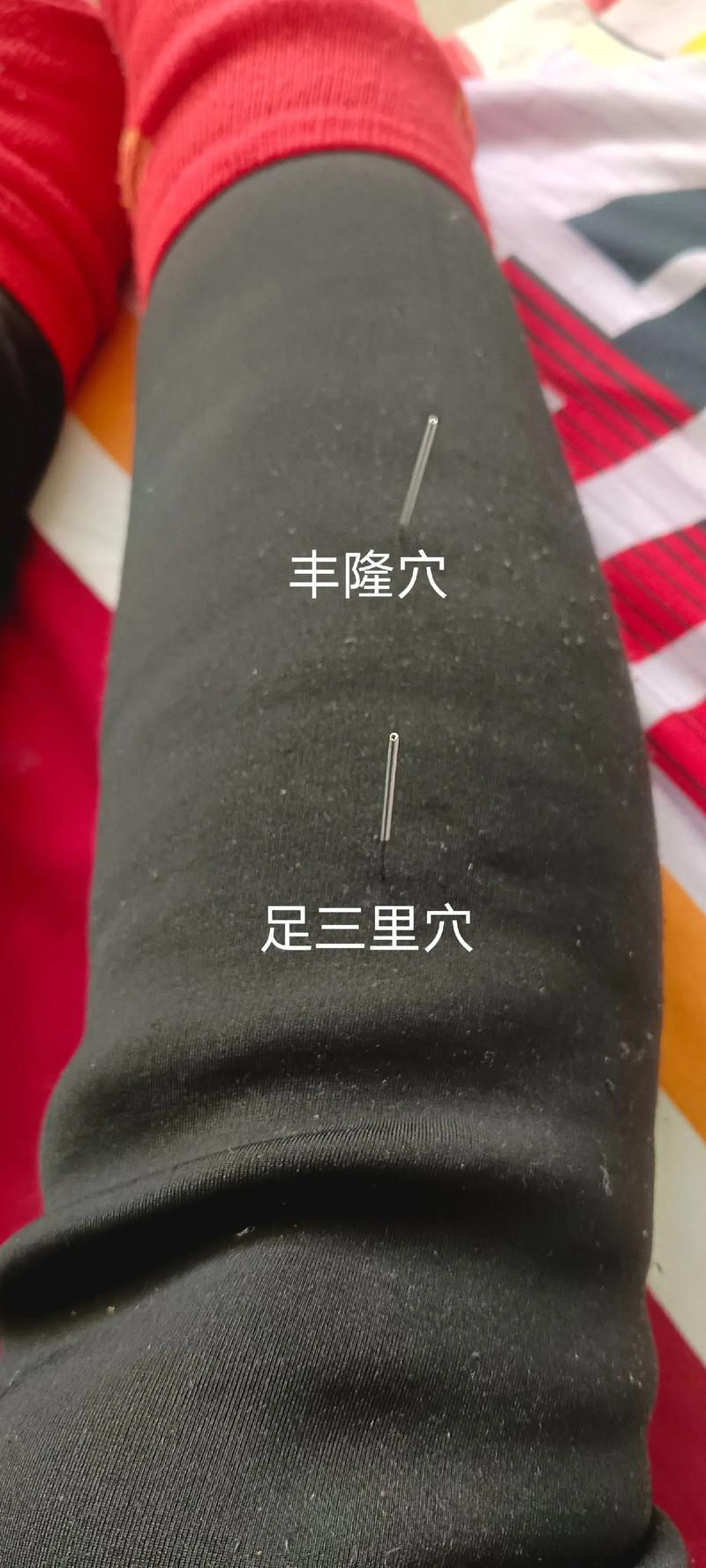 高血脂针灸什么穴位