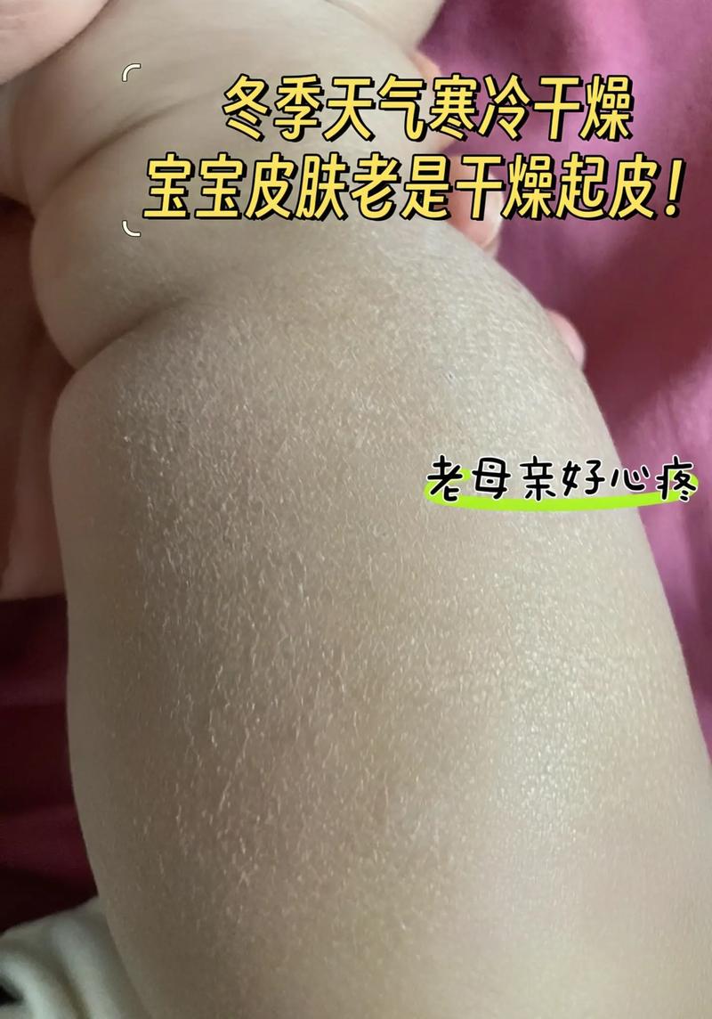 宝宝身上起风湿怎么办