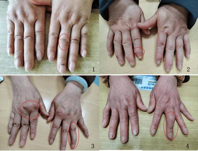 类风湿关节炎手腕畸形
