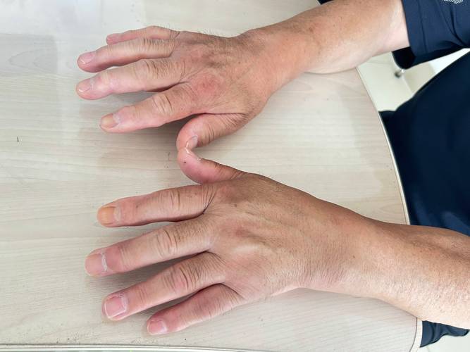类风湿关节炎手腕畸形