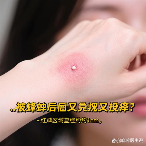 类风湿用蜂子能蛰好吗