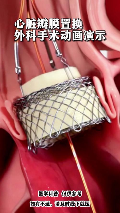 风湿性心脏瓣膜置换术
