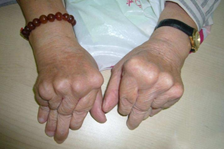 类风湿关节炎常见症状