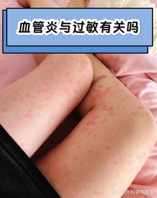 类风湿会引起血管炎吗