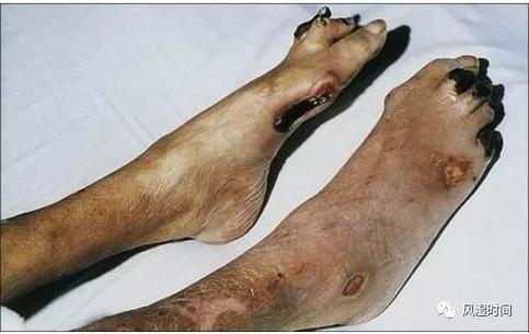 类风湿会引起血管炎吗