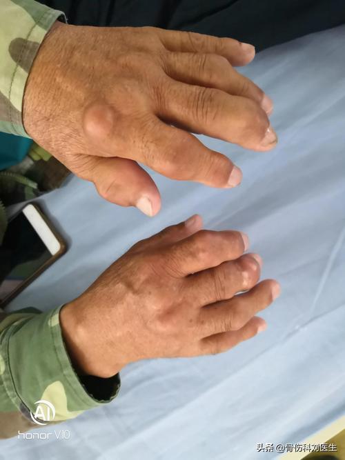 风湿三项正常但是晨僵