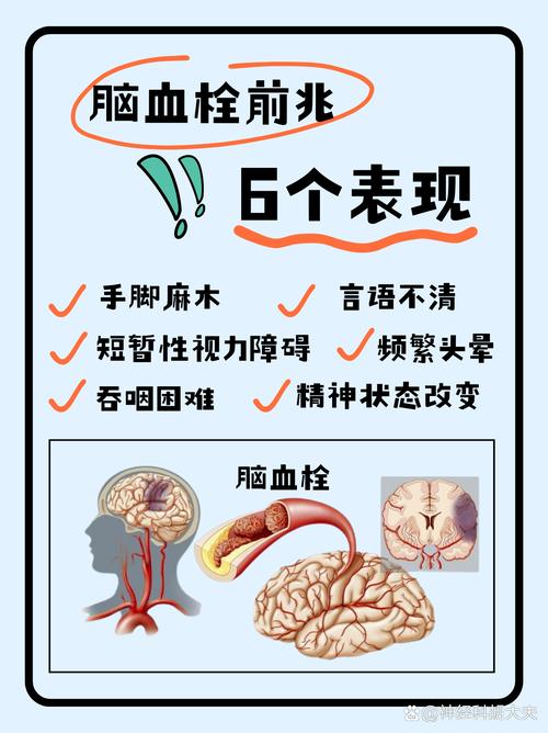 脑梗前兆有没有危险性