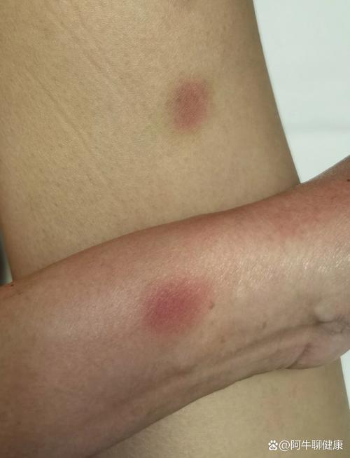 风湿性结节性红斑图片