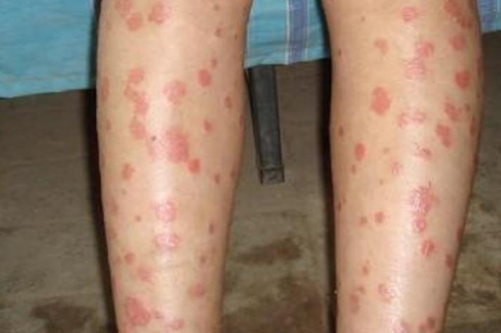 风湿性结节性红斑图片