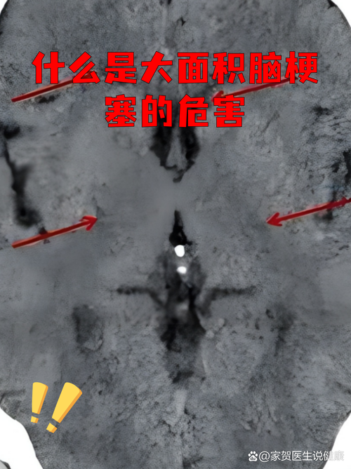 脑梗面积大了会怎么样