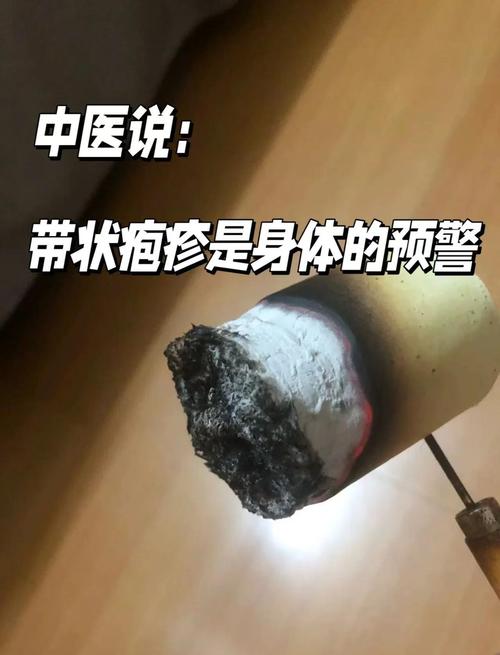 治疗疱疹的穴位治疗