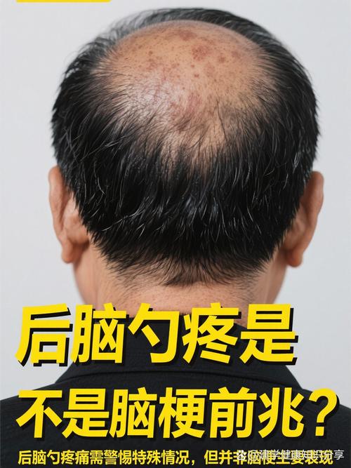 头发胀是脑梗的前兆吗