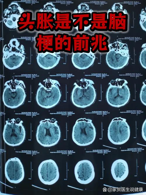 头发胀是脑梗的前兆吗