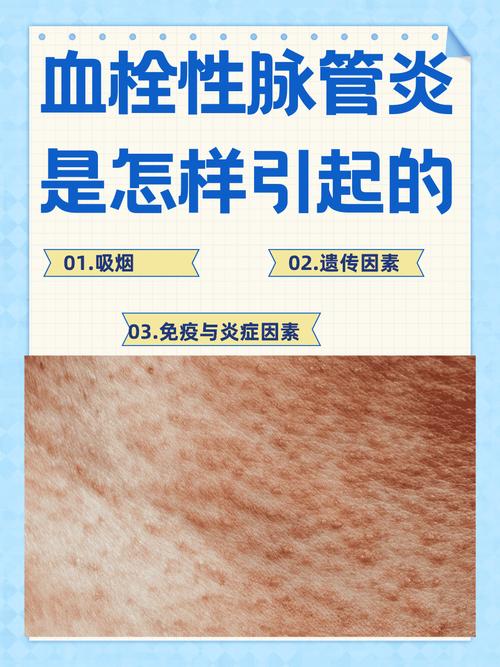 风湿免疫科看血管炎吗