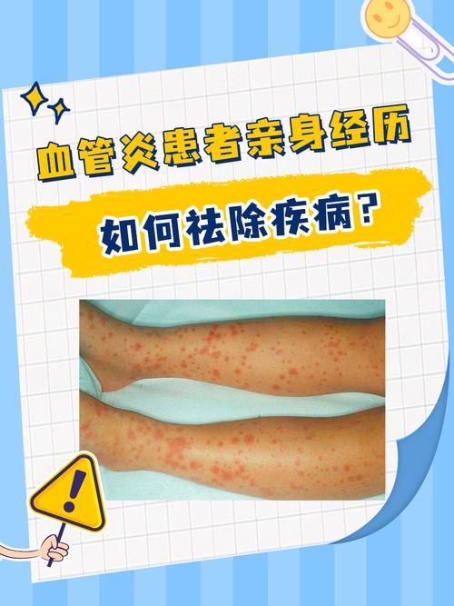 风湿免疫科看血管炎吗