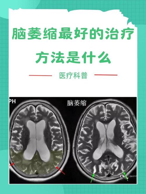 脑梗和小脑萎缩怎么治