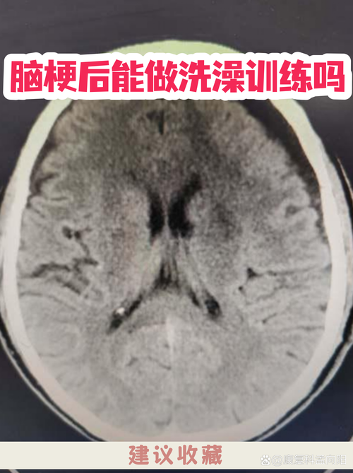 脑梗急性期洗澡可以吗