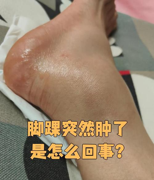 风湿关节炎引起的脚肿