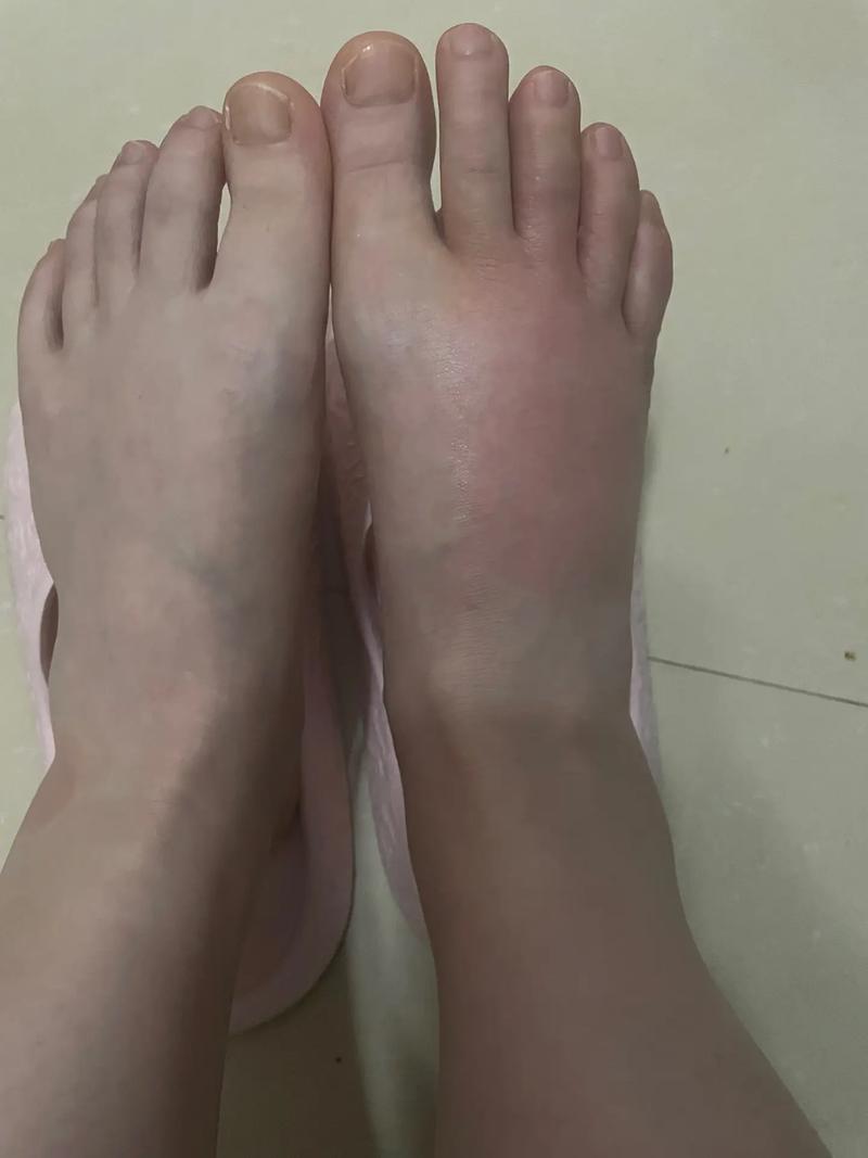 风湿关节炎引起的脚肿