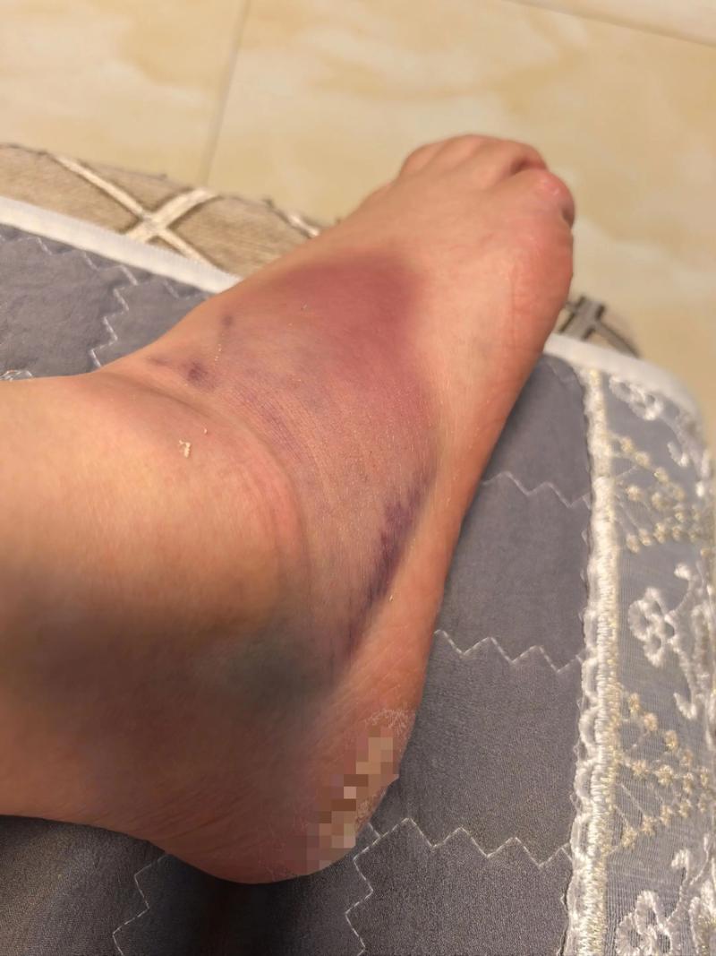 风湿关节炎引起的脚肿