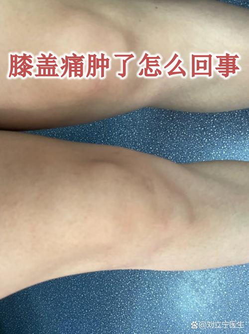 风湿性膝盖滑膜炎症状