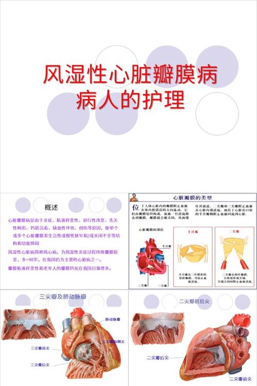 类风湿心脏病怎么治疗