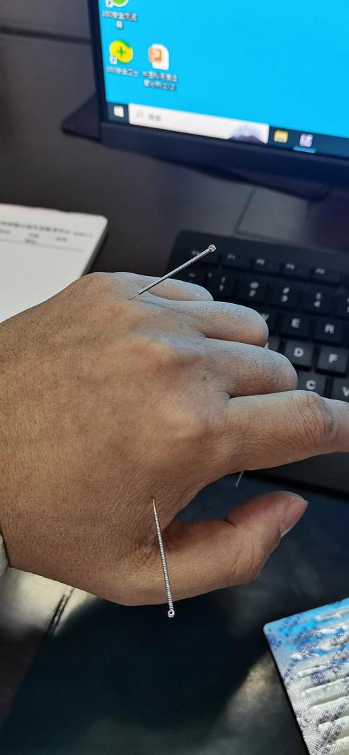 感冒用哪个针灸穴位