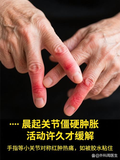 类风湿手指关节炎图片