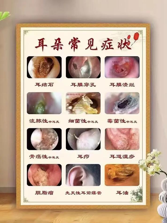 脑梗会不会引起中耳炎