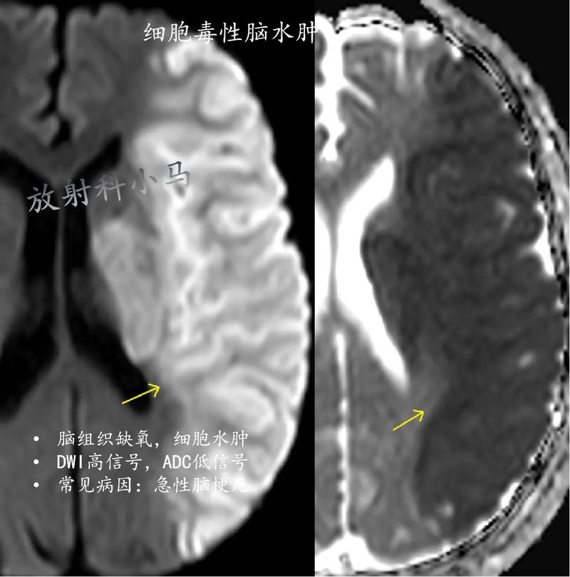 脑梗一般都会脑水肿吗