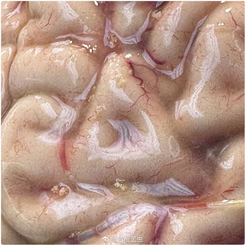 脑梗一般都会脑水肿吗