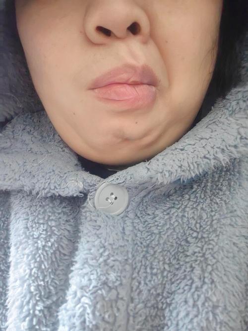 脑梗病人恢复期嘴歪了