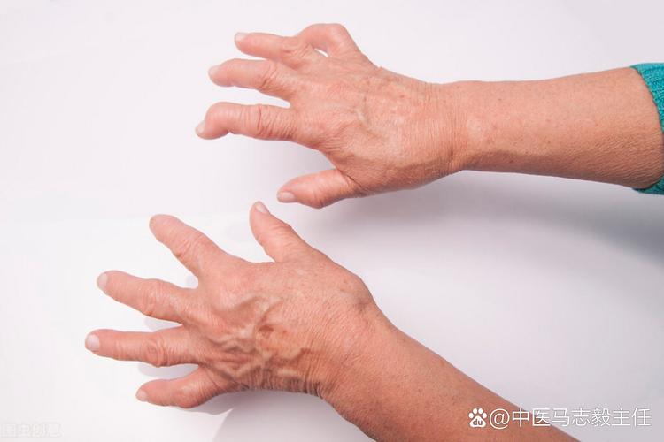 类风湿关节炎急性发作