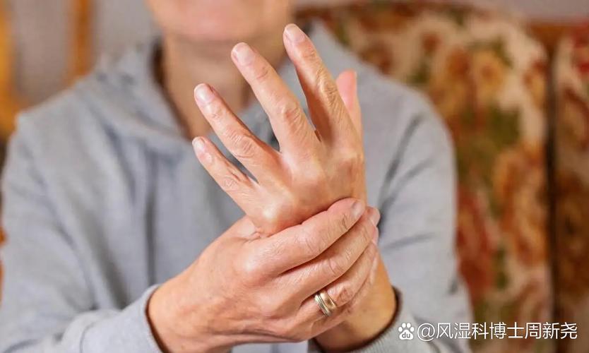 类风湿关节炎急性发作